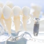 Jak przygotować się do implantów dentystycznych?